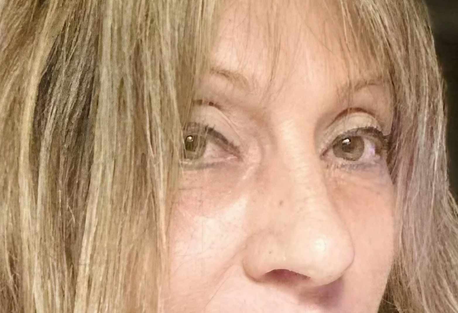Después del procedimiento